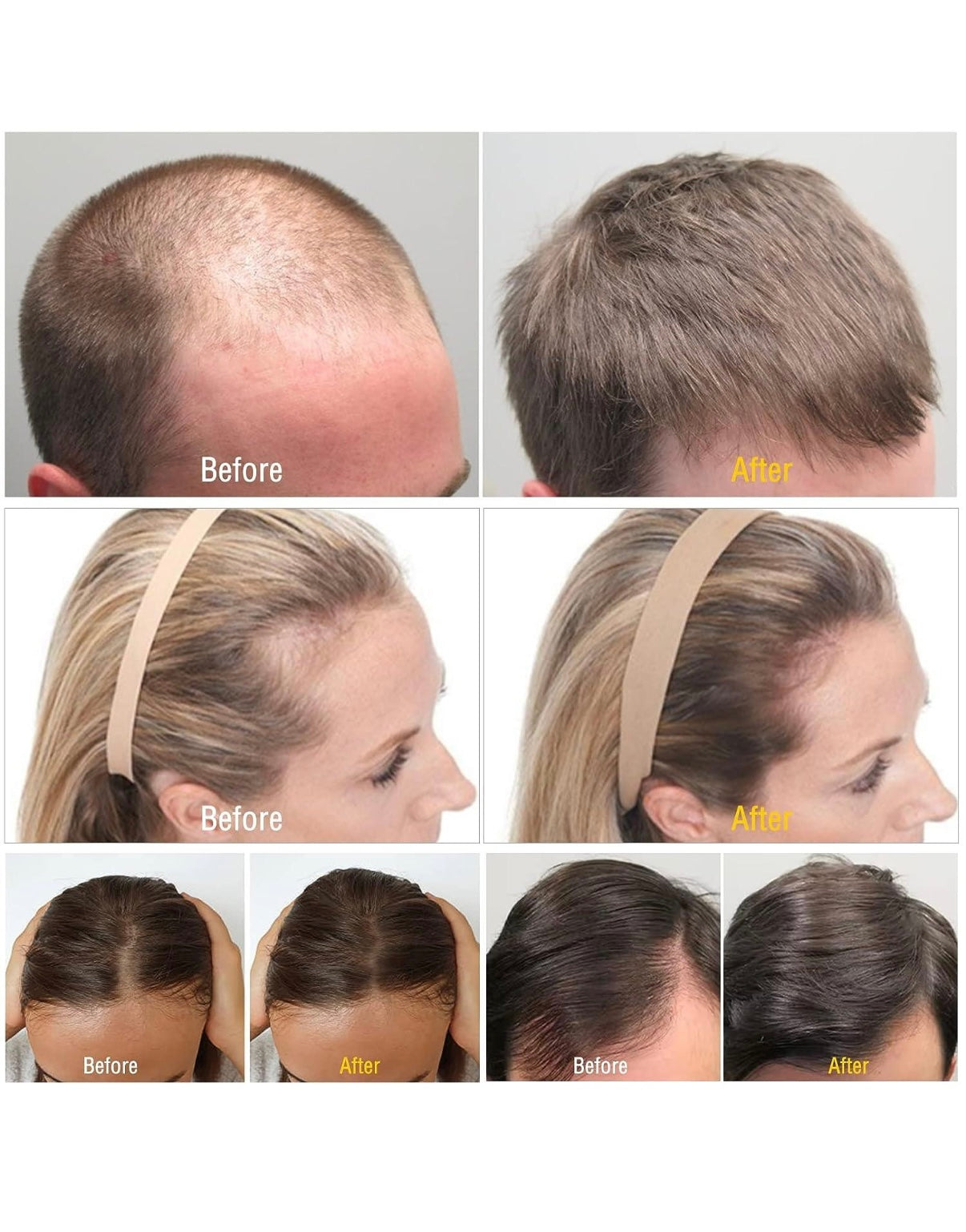 Derma Roller 0,25 mm